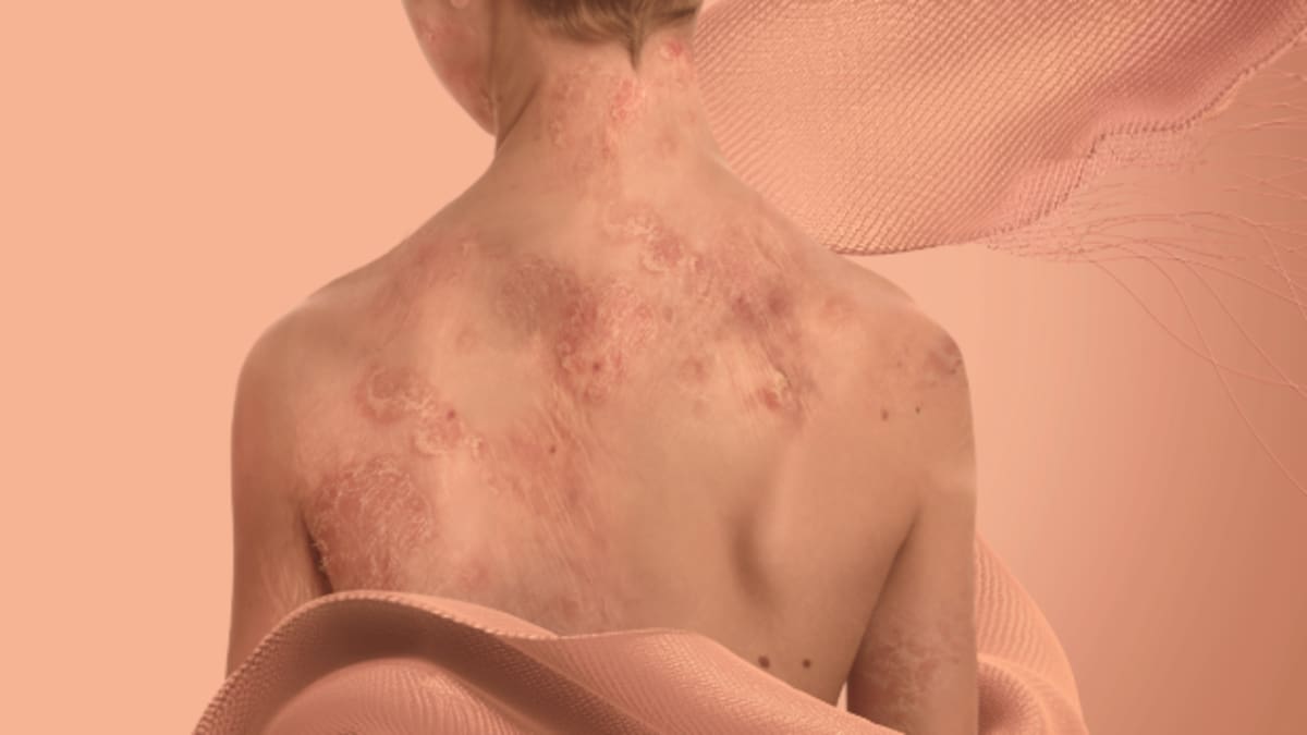 Familias de pacientes con Piel de Mariposa enfrentan una dura batalla para recibir atención en Colombia