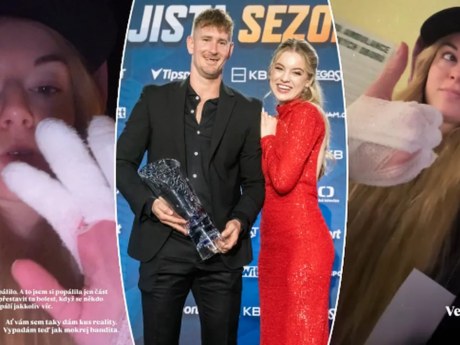 Michaela Pecháčková se při vaření popálila, skončila na pohotovosti