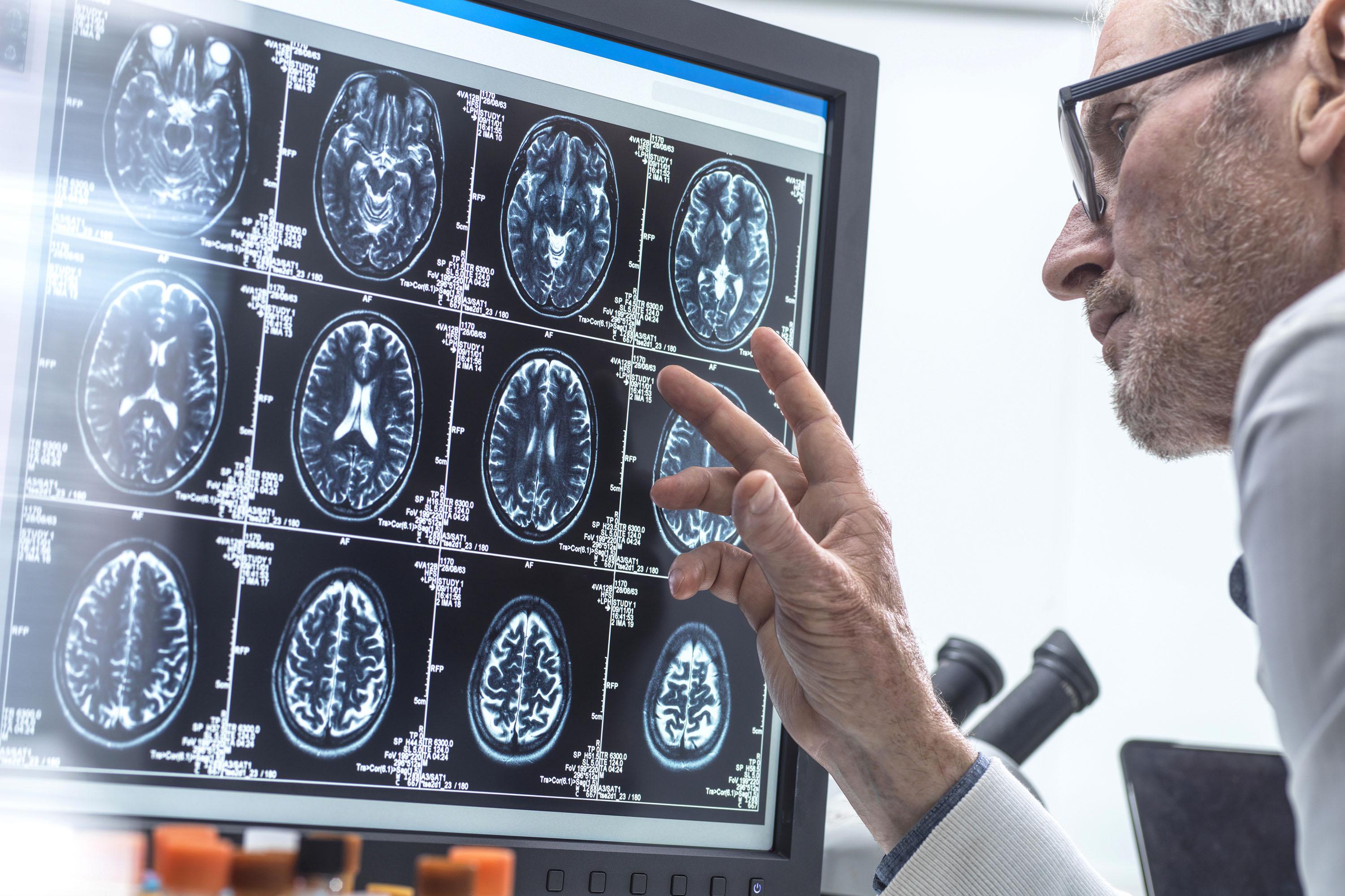 Nakon 30 godina istraživanja FDA odobrila prvi lijek za rijetku neurološku bolest koja najčešće pogađa malu djecu