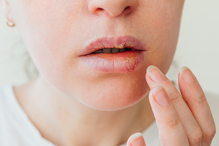 Herpes nije samo neugoda na usnama: znanstvenici otkrili što virus radi stanicama u mozgu